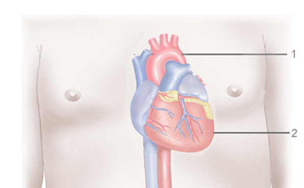 Abdominal Aortic Aneurysm